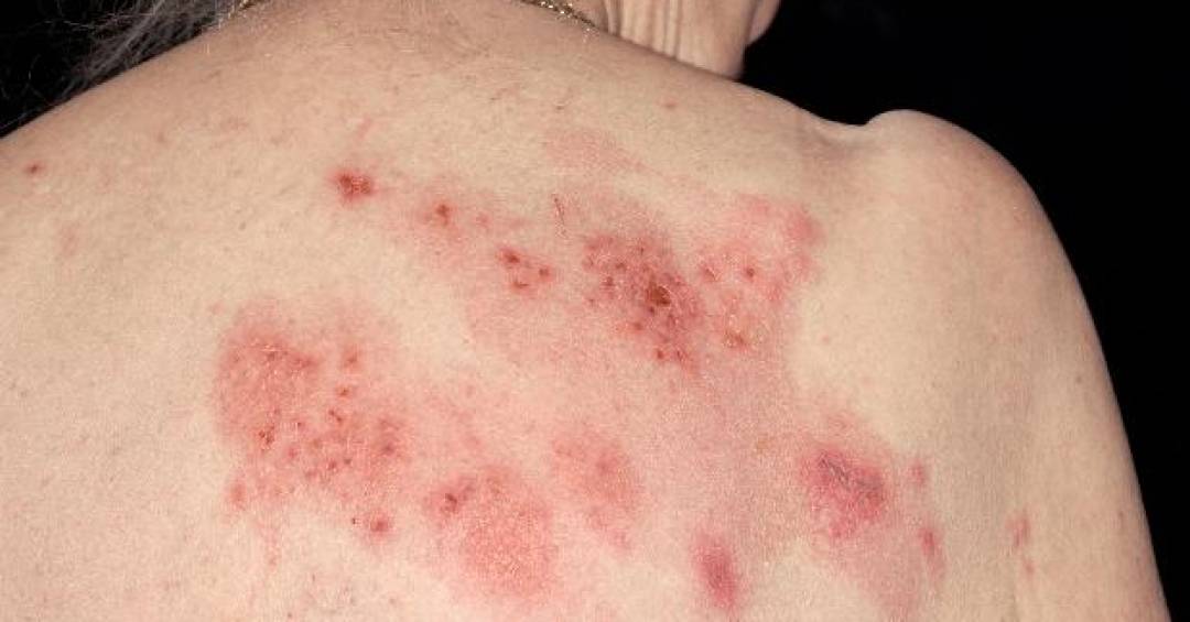 Canetas emagrecedoras e herpes: o alerta que vem de uma nova an�lise com milhares de usu�rios