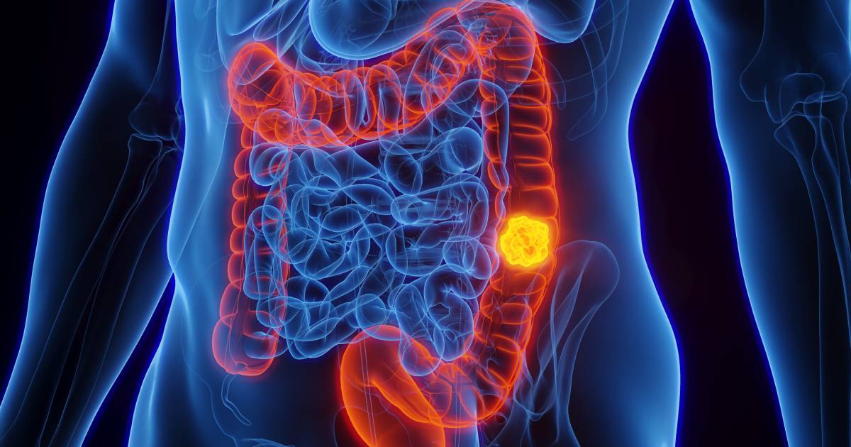 Estudo relaciona bact�ria que afeta est�mago a um em cada cinco casos de c�ncer colorretal